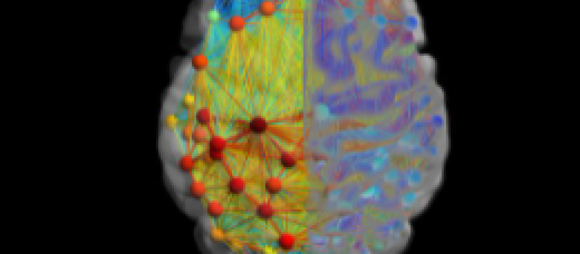 TMS to treat depression